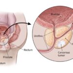 The Shocking Truth: What Are the Worst Foods for Your Prostate ? 6 Foods That May Increase-state Cancer Risk!”